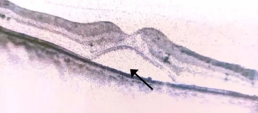 How to Identify Macular Edema in OCT Examination