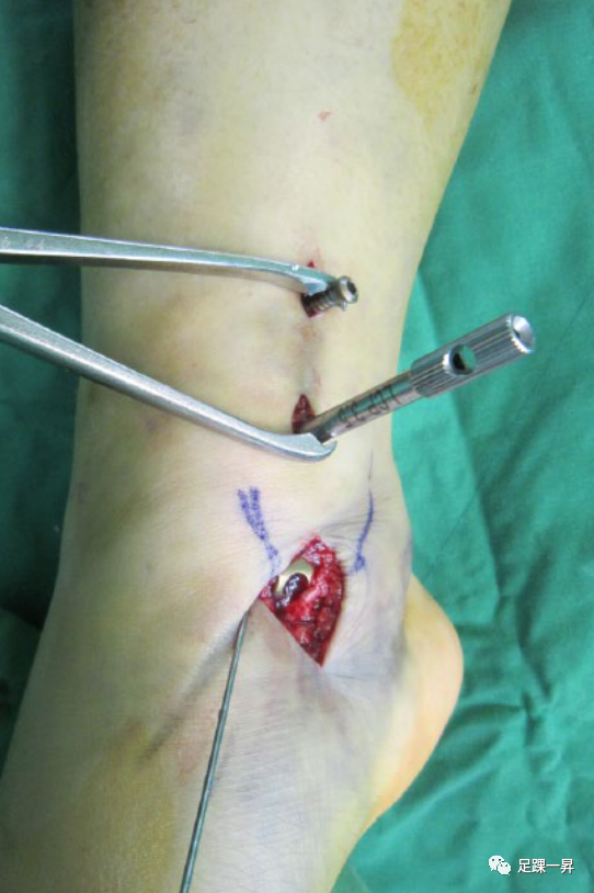 Application of 3D Printing Technology in Complex Tibial Fractures
