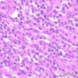 Understanding Diffuse Large B-Cell Lymphoma