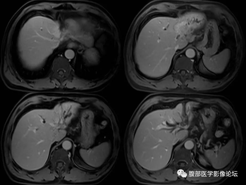 Cholangiocarcinoma: Insights and Clinical Perspectives