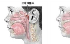 Diagnosis and Treatment of Adenoid Hypertrophy and Complications