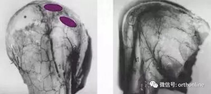Introduction and Resetting Tips for Proximal Humerus Multilock Intramedullary Nail