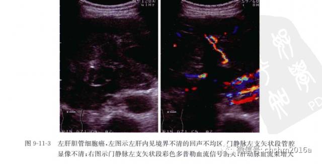 Ultrasound Imaging of Intrahepatic Cholangiocarcinoma
