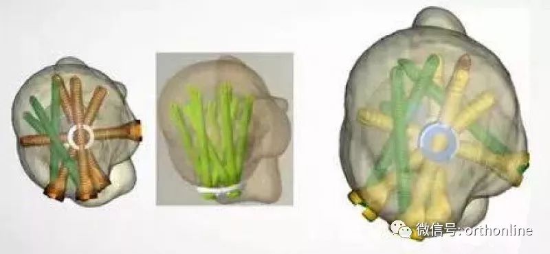 Introduction and Resetting Tips for Proximal Humerus Multilock Intramedullary Nail