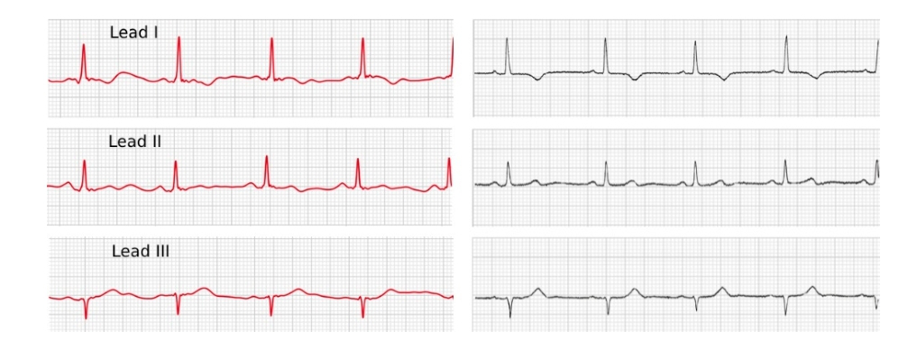 Mastering Smartwatches: Transforming Into An ECG Machine