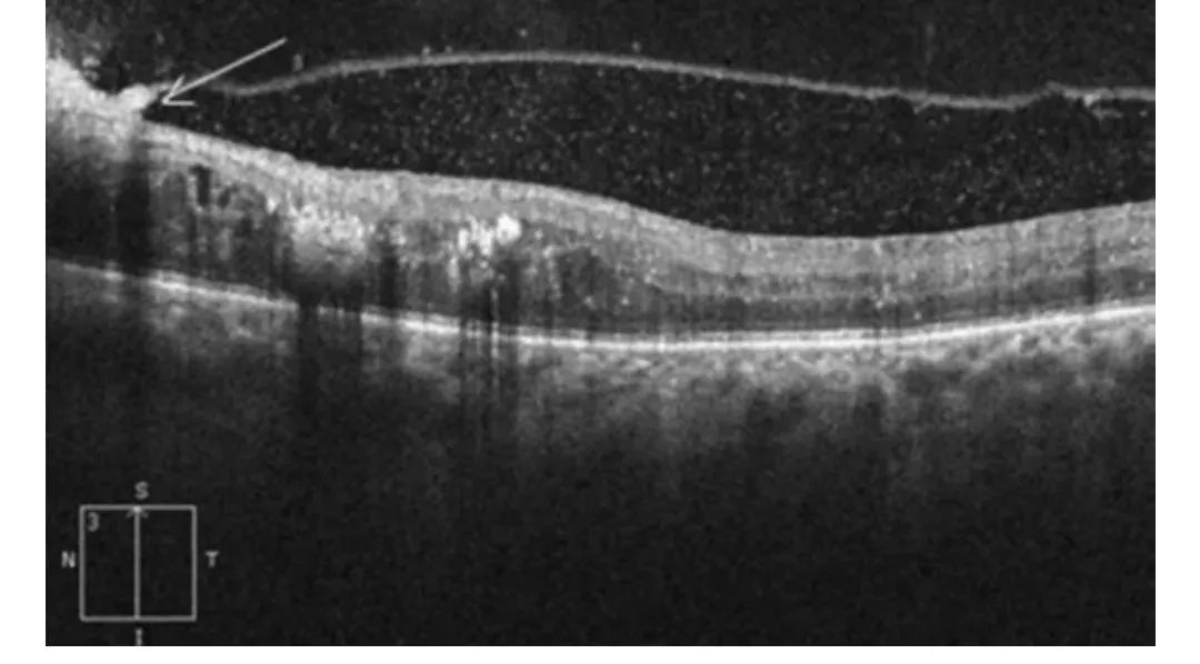 How to Identify Macular Edema in OCT Examination