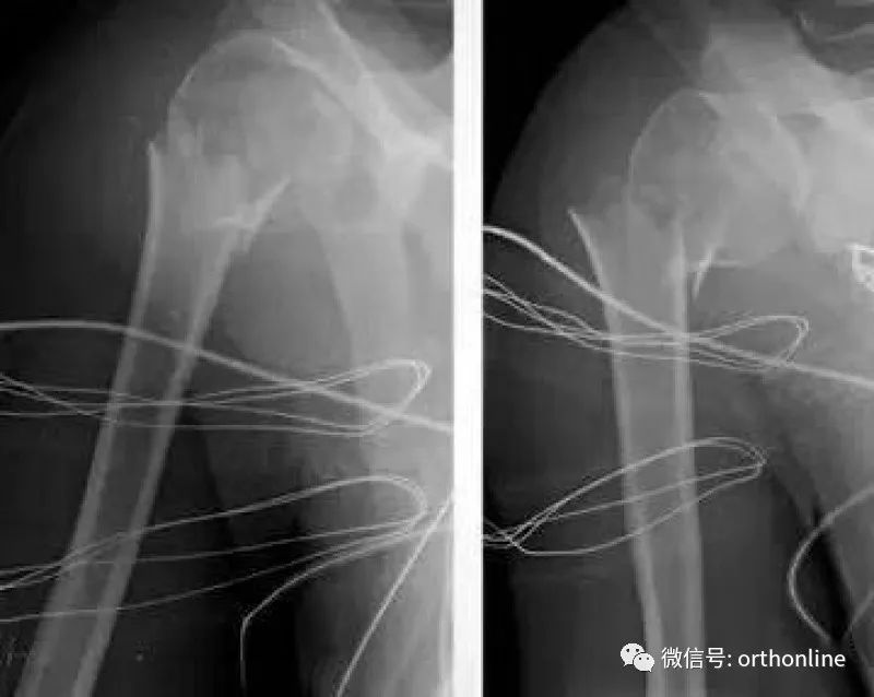Introduction and Resetting Tips for Proximal Humerus Multilock Intramedullary Nail