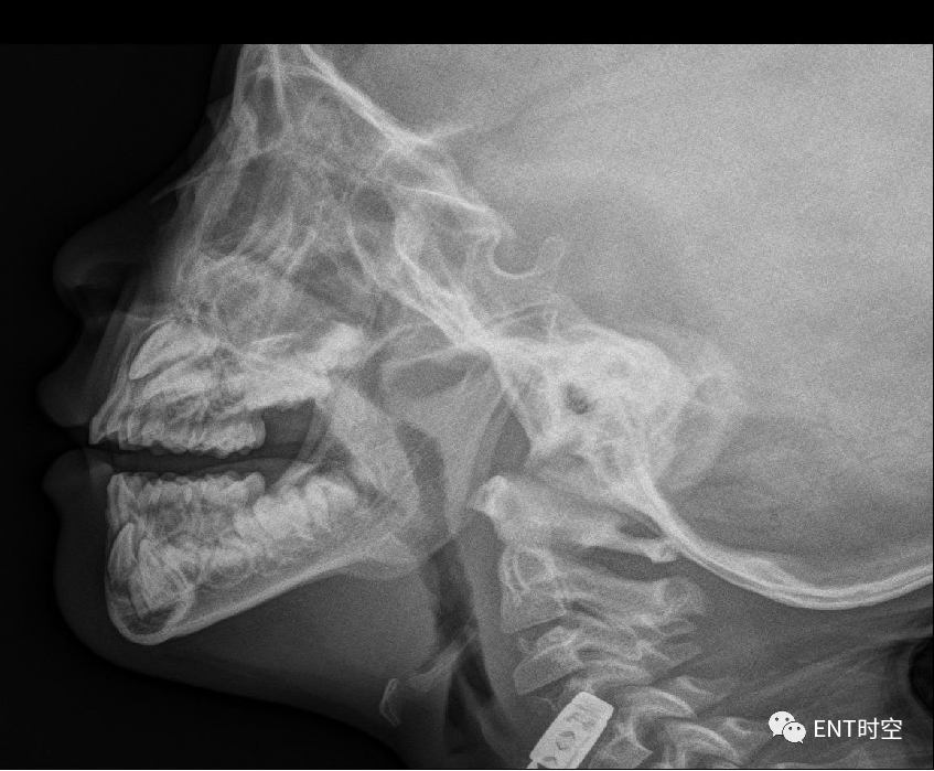 Diagnosis and Treatment of Adenoid Hypertrophy and Complications