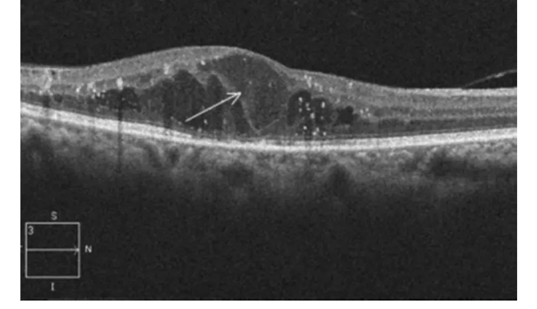 How to Identify Macular Edema in OCT Examination