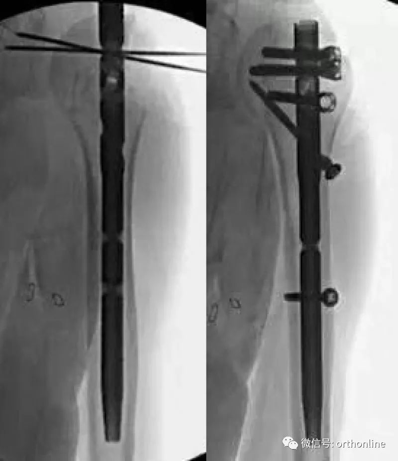 Introduction and Resetting Tips for Proximal Humerus Multilock Intramedullary Nail