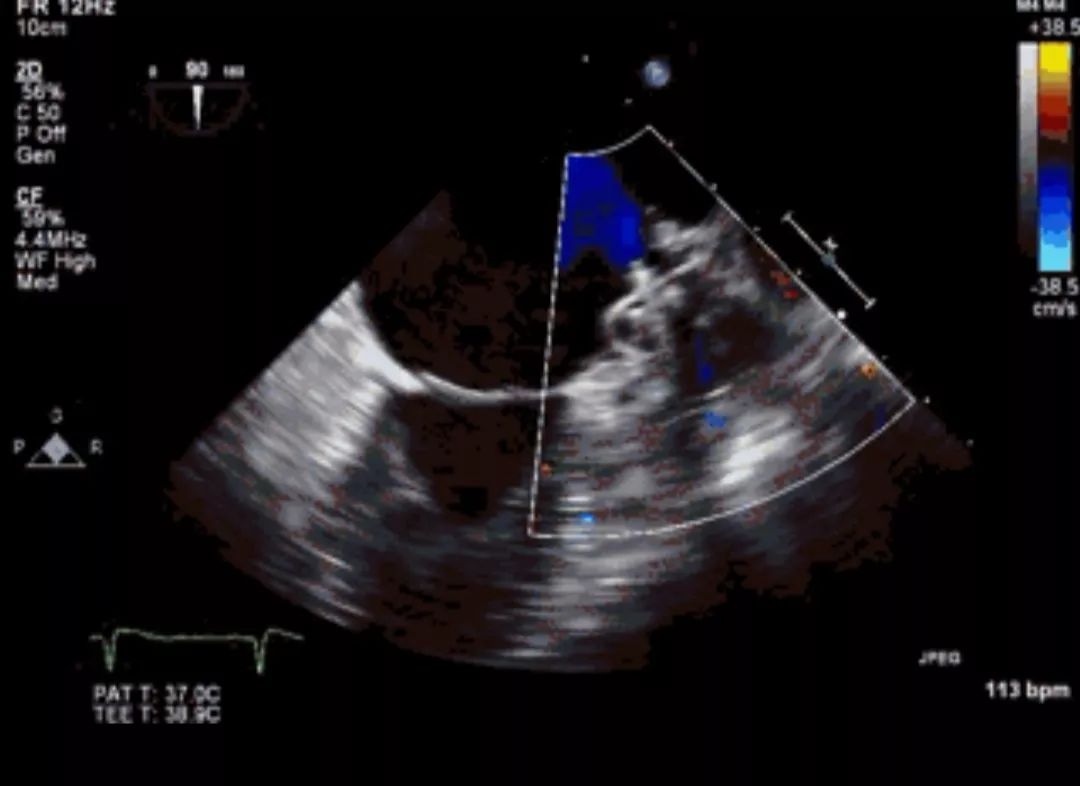 Cardiac CTA as a Replacement for Esophageal Echocardiography After LAAC
