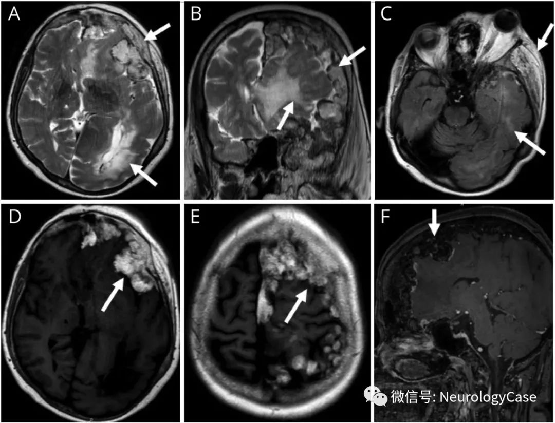 Clinical And Neuroimaging Features Of Encephalocraniocutaneous Lipomatosis