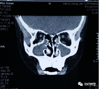 Diagnosis and Treatment of Adenoid Hypertrophy and Complications