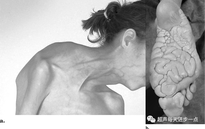 Proteus Syndrome: Characteristics and Diagnosis