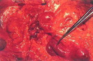 Comprehensive Review of Current Advances in Intrahepatic Cholangiocarcinoma Treatment