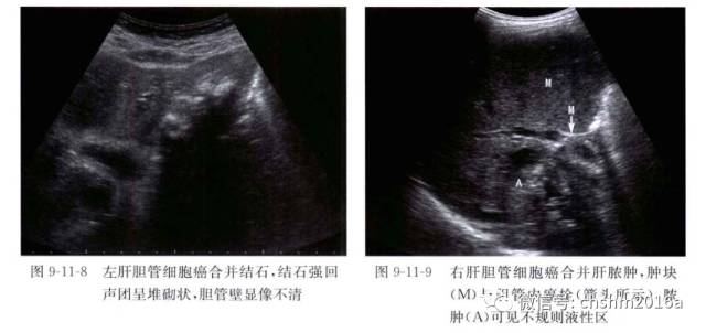 Ultrasound Imaging of Intrahepatic Cholangiocarcinoma