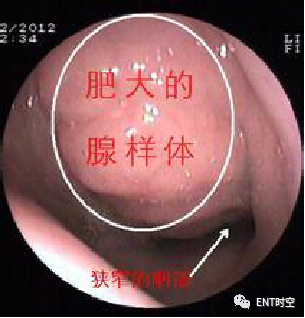 Diagnosis and Treatment of Adenoid Hypertrophy and Complications