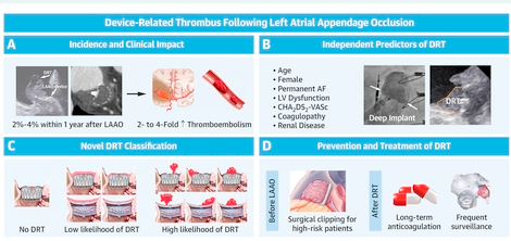 Exploring Left Atrial Appendage Occlusion Device-Related Thrombosis: Clinical Impact, Risk Prediction, Differentiation, and Management
