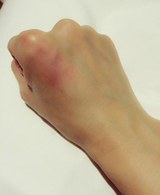 The Great Uses of Vitamin C in Treating Injuries