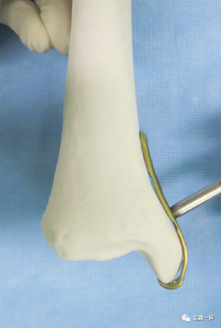 Application of 3D Printing Technology in Complex Tibial Fractures