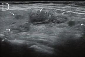 Which Thyroid Nodules Require Surgical Removal? Exploring C-TIRADS Classification