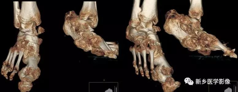 Overview of Proteus Syndrome