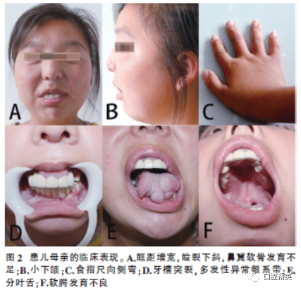 Clinical Analysis of 5 Cases of Oral-Facial-Digital Syndrome Type I