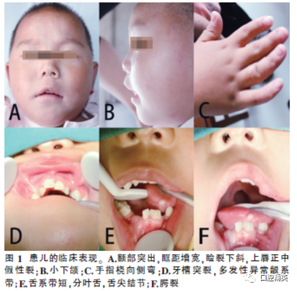 Clinical Analysis of 5 Cases of Oral-Facial-Digital Syndrome Type I