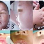 Clinical Analysis of 5 Cases of Oral-Facial-Digital Syndrome Type I