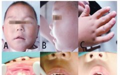 Clinical Analysis of 5 Cases of Oral-Facial-Digital Syndrome Type I