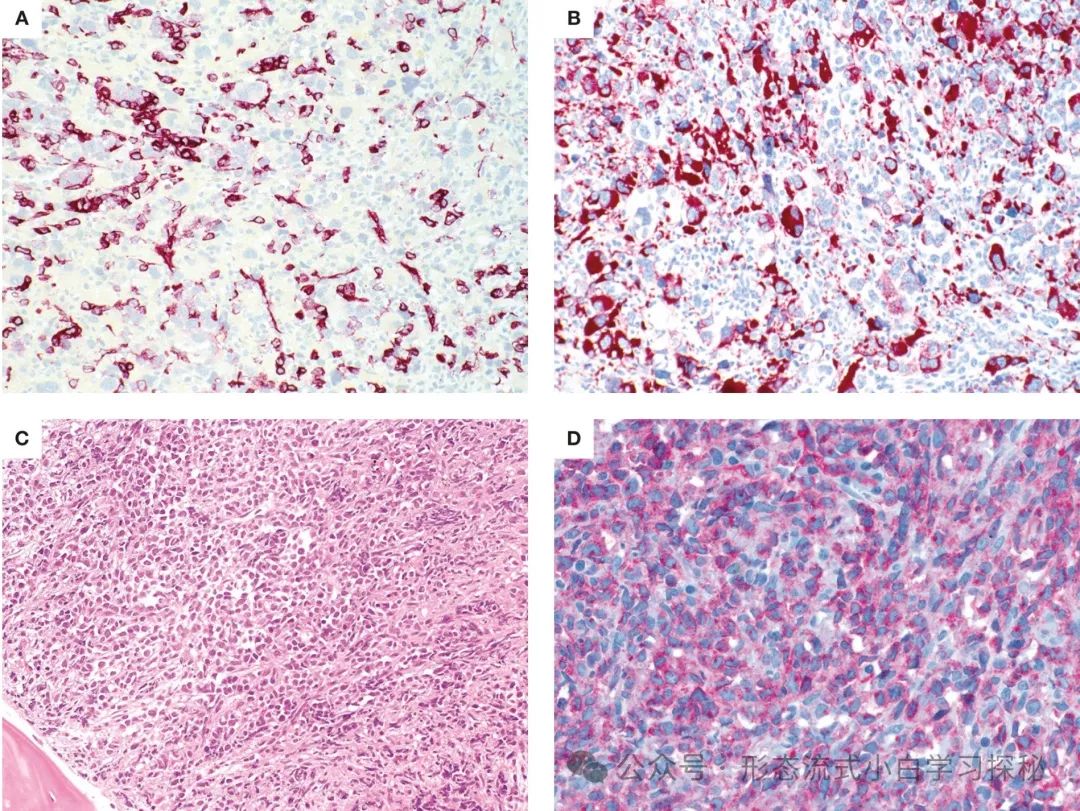Chapter 1: Chronic Myeloid Leukemia