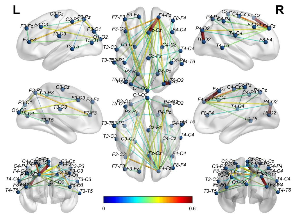 HBM: Spatial-Temporal Graph Convolutional Networks for Alzheimer's Diagnosis Using Brain Functional Connectivity