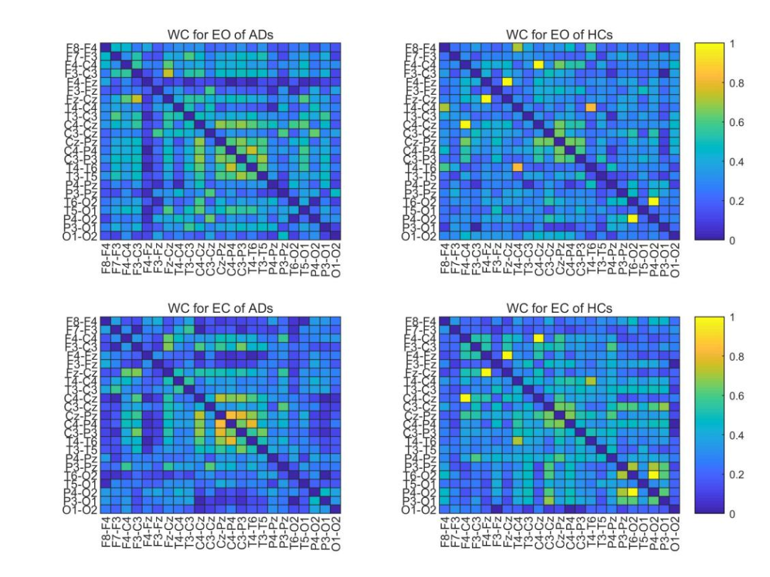HBM: Spatial-Temporal Graph Convolutional Networks for Alzheimer's Diagnosis Using Brain Functional Connectivity