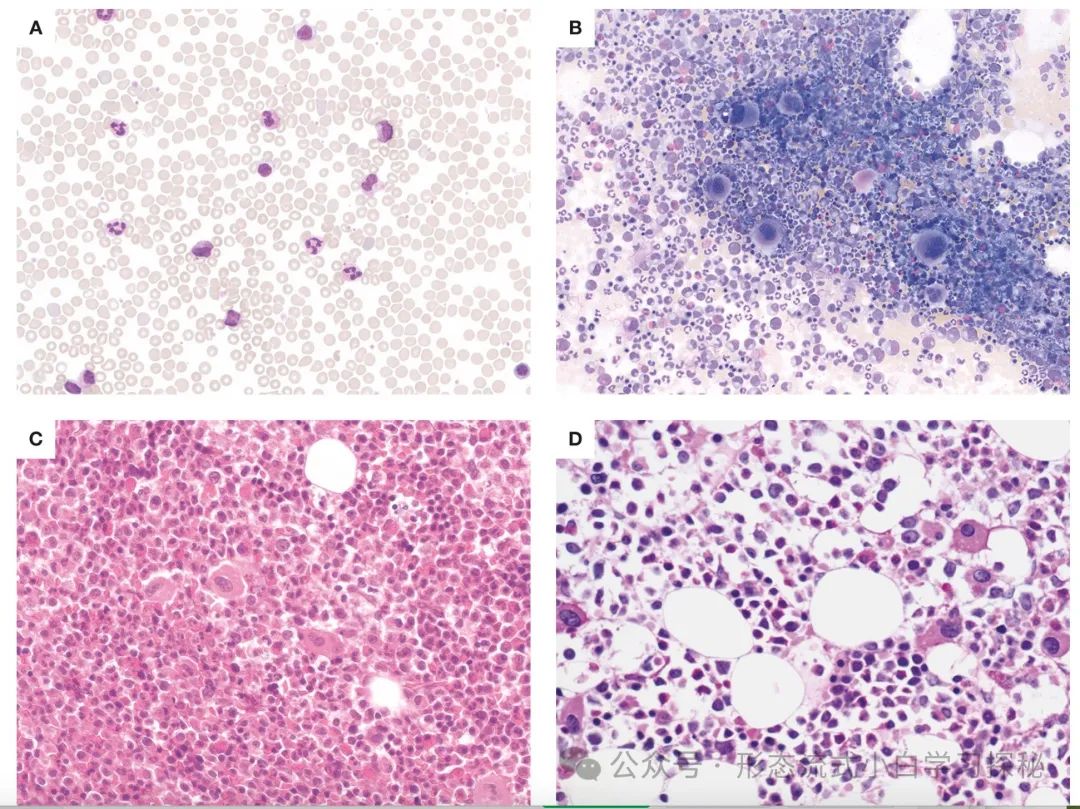 Chapter 1: Chronic Myeloid Leukemia