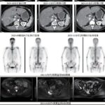 RC88 Treatment for Platinum-Resistant Ovarian Cancer with Liver/Bone/Lymph Node Metastases: A Case Report