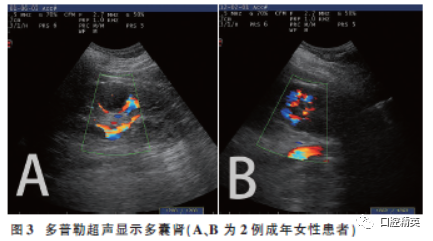 Clinical Analysis of 5 Cases of Oral-Facial-Digital Syndrome Type I