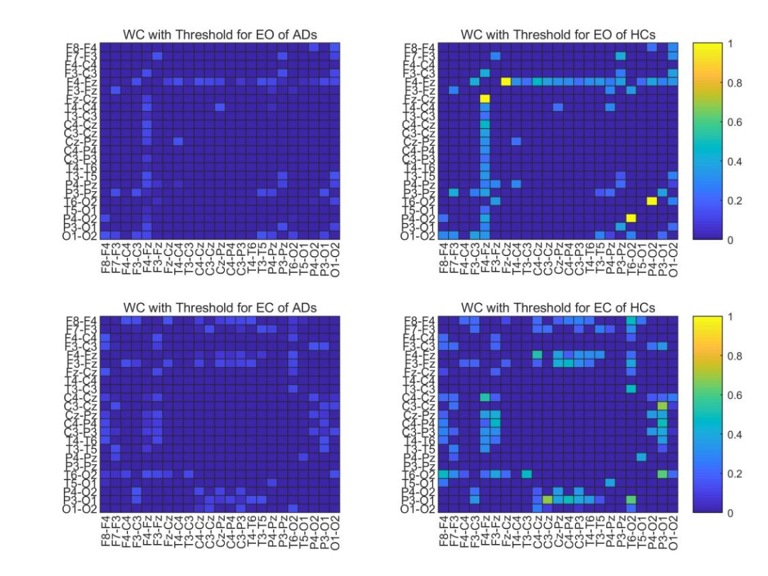 HBM: Spatial-Temporal Graph Convolutional Networks for Alzheimer's Diagnosis Using Brain Functional Connectivity