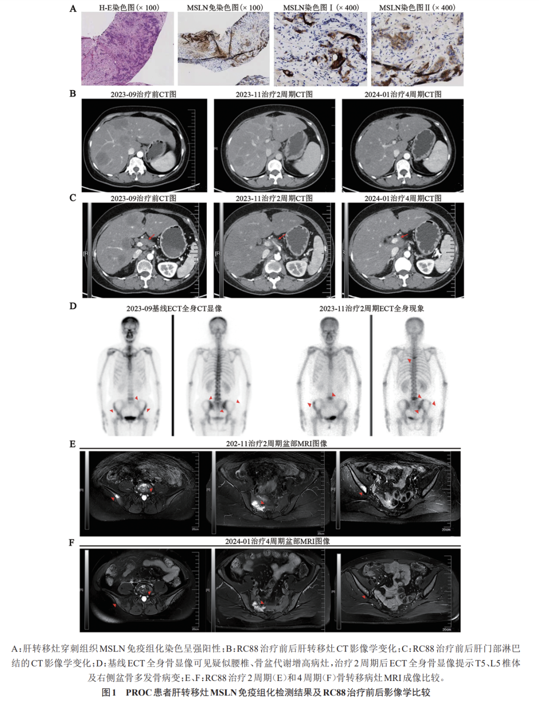 RC88 Treatment for Platinum-Resistant Ovarian Cancer with Liver/Bone/Lymph Node Metastases: A Case Report