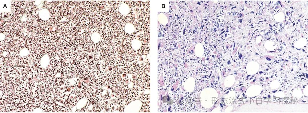 Chapter 1: Chronic Myeloid Leukemia