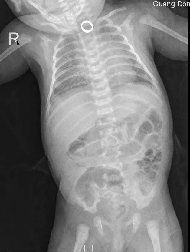 A Baby in Guangdong Swallowed a Gold Ring on Her Full Moon Celebration, and What Happened Next Was Terrifying