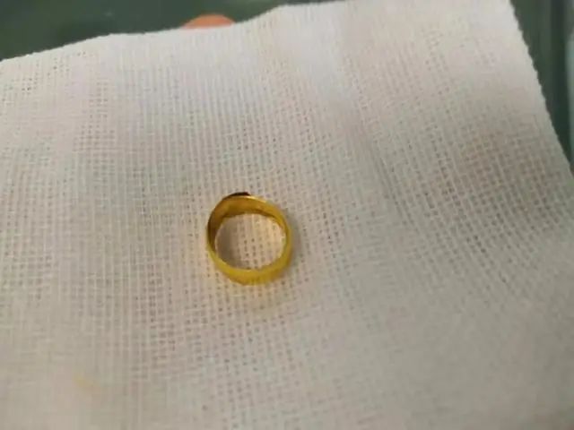 A Baby in Guangdong Swallowed a Gold Ring on Her Full Moon Celebration, and What Happened Next Was Terrifying
