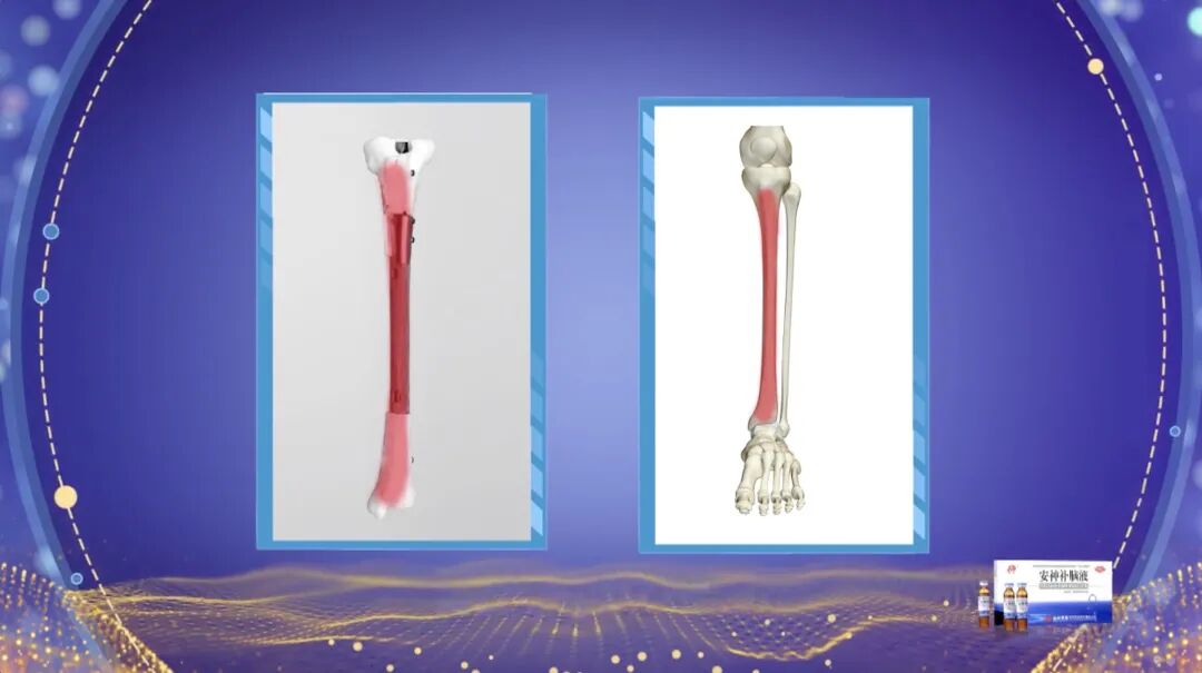 3D Printing: Custom Bone Solutions! Discover Innovative Technologies in Orthopedics