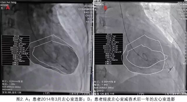 Chen Wei: Application of Percutaneous Left Ventricular Reconstruction in Ischemic Heart Failure