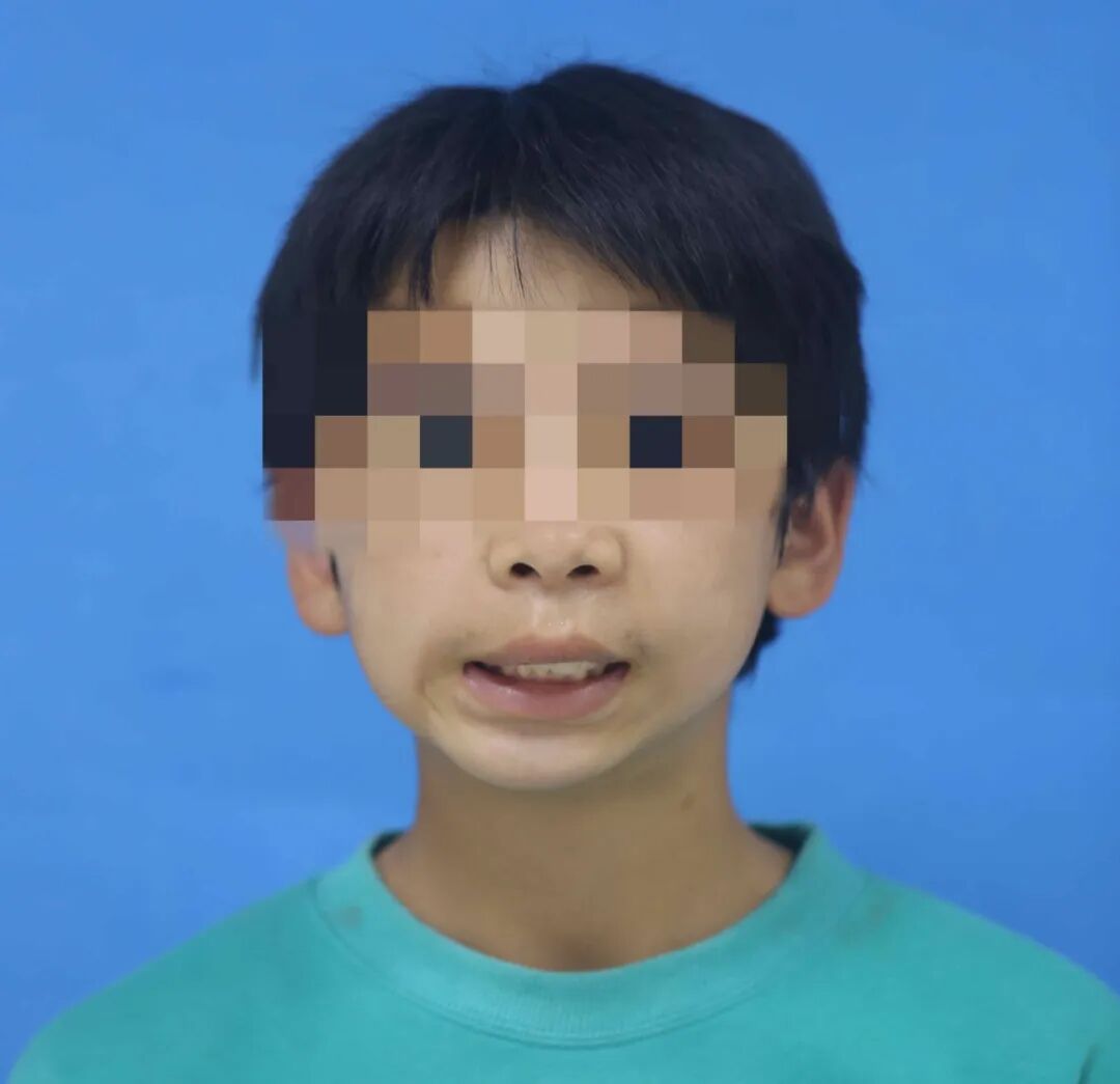 Ningxia's First Case: 14-Year-Old Boy Rebuilds Jaw with 3D Printing!
