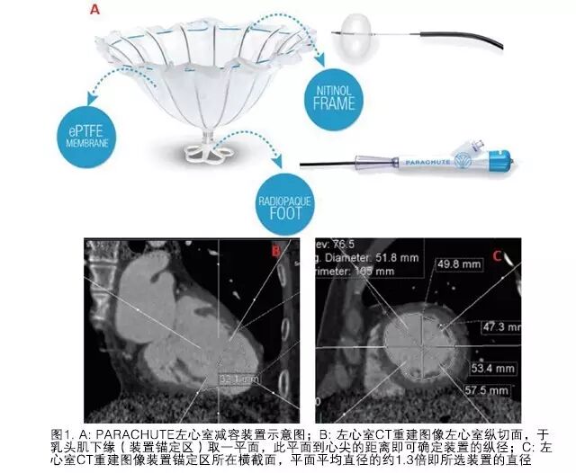Chen Wei: Application of Percutaneous Left Ventricular Reconstruction in Ischemic Heart Failure