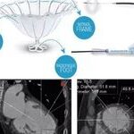 Chen Wei: Application of Percutaneous Left Ventricular Reconstruction in Ischemic Heart Failure