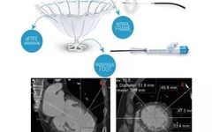 Chen Wei: Application of Percutaneous Left Ventricular Reconstruction in Ischemic Heart Failure