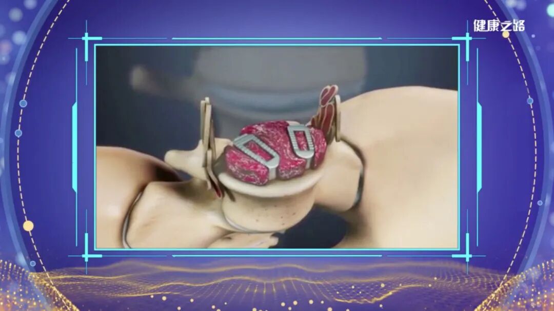 3D Printing: Custom Bone Solutions! Discover Innovative Technologies in Orthopedics