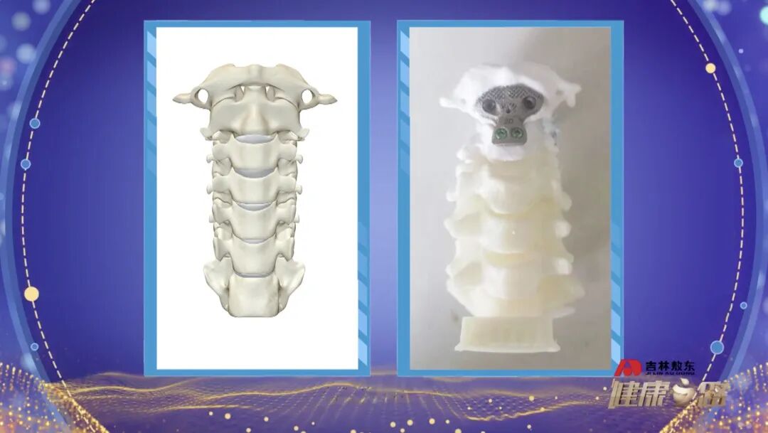 3D Printing: Custom Bone Solutions! Discover Innovative Technologies in Orthopedics