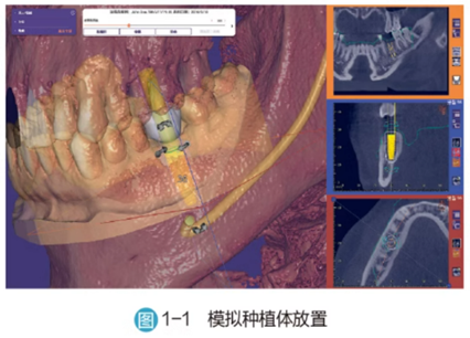 Application of 3D Printing in Digital Implant Surgical Guides